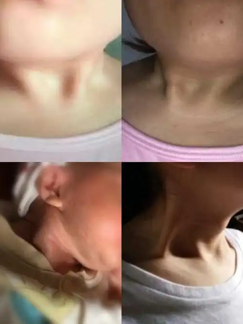 胸锁乳突肌的锁骨头,在发育过程中较健侧明显的短了.