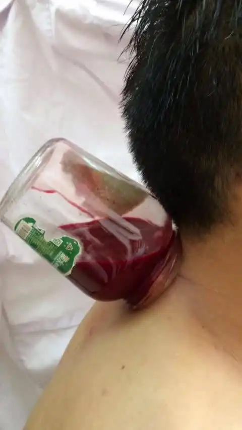 刺血泰斗马永祥的微博视频