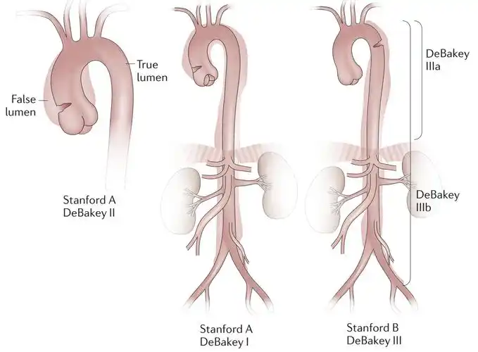 主动脉夹层及其分型