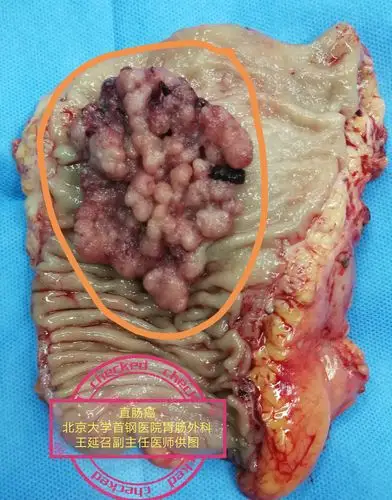 直肠癌手术切除是优选方案吗