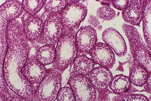 显微镜下的癌细胞癌细胞的内外潜藏着自身无法克服和无法排除的逆转