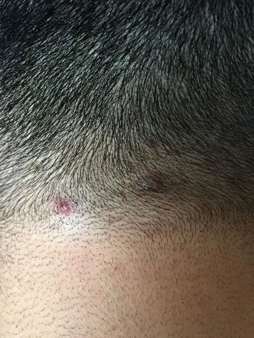 秋季男性的头皮毛囊炎图片_有来医生