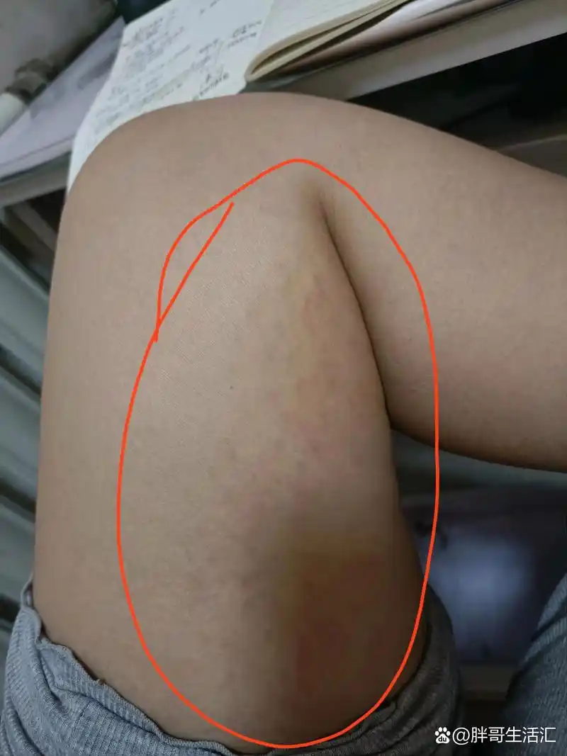 产后三个月了,最近发现大腿内侧好多红道道,和妊娠纹有点像,但是摸