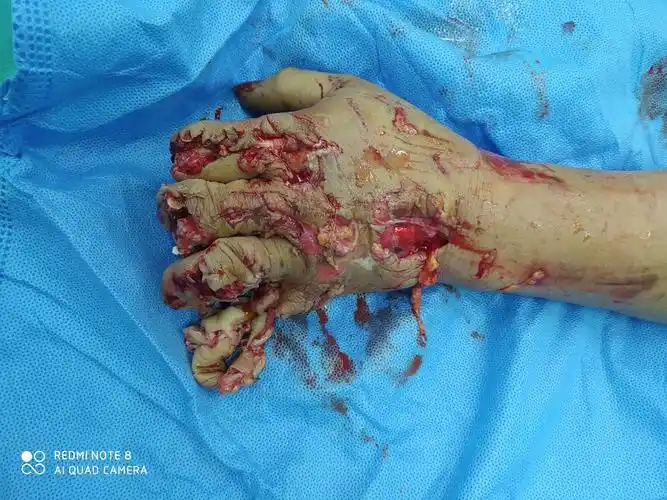 两例严重手外伤治疗的收获和遗憾