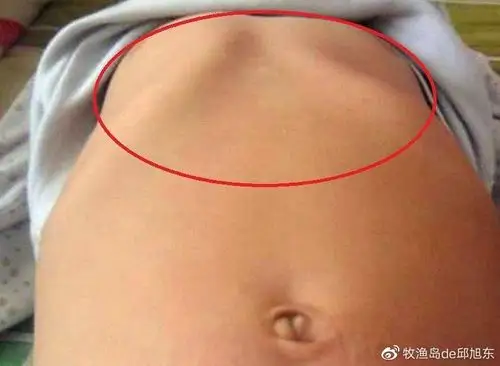 宝宝胸骨可能会突出.