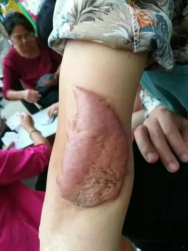 植皮手术小分子肽两盒的效果.