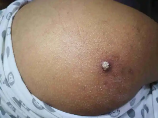 屁股长白色的疙瘩一个,请问这是什么病,怎么治疗