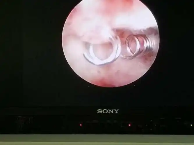 近啦,更近啦.听大夫说这叫宫腔镜下取环术,是微创先进技术.