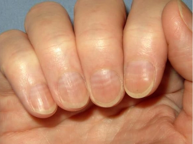 女性气血足不足,看"指甲"就知道?建议:常吃4物,补血提气色