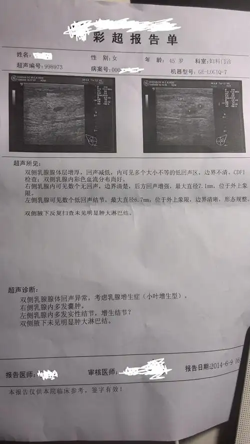 乳腺增生结节的介绍