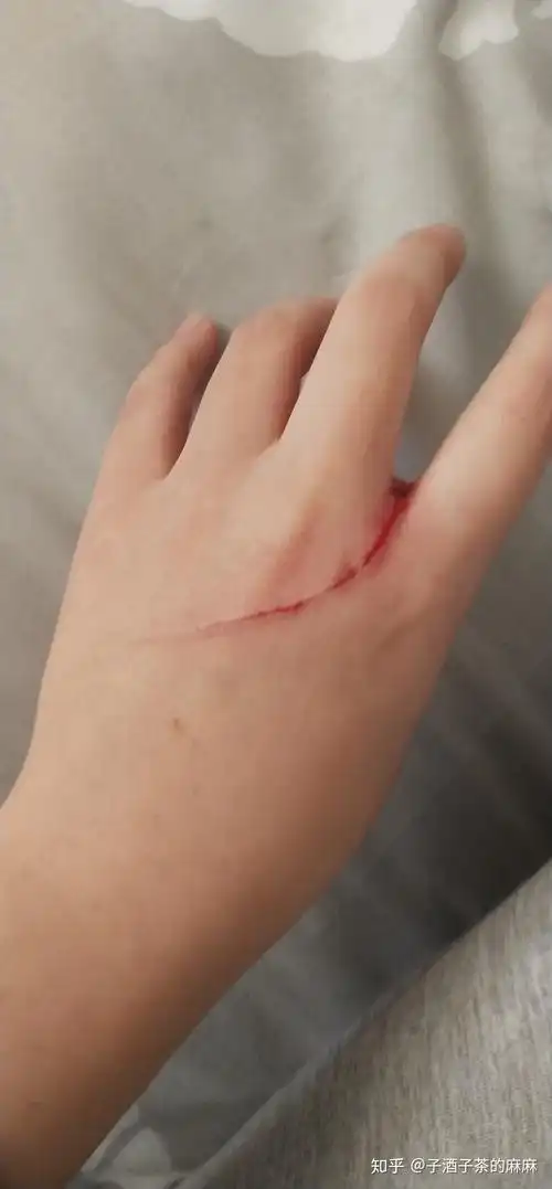 为什么左手被刮伤右手同样位置也痛