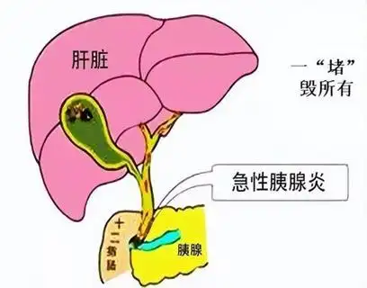 小心急性胰腺炎来给你"拜年"|血症|胆道|胆囊炎|胆结石_网易订阅