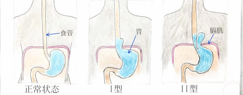 查体发现食管裂孔疝保守治疗还是手术治疗