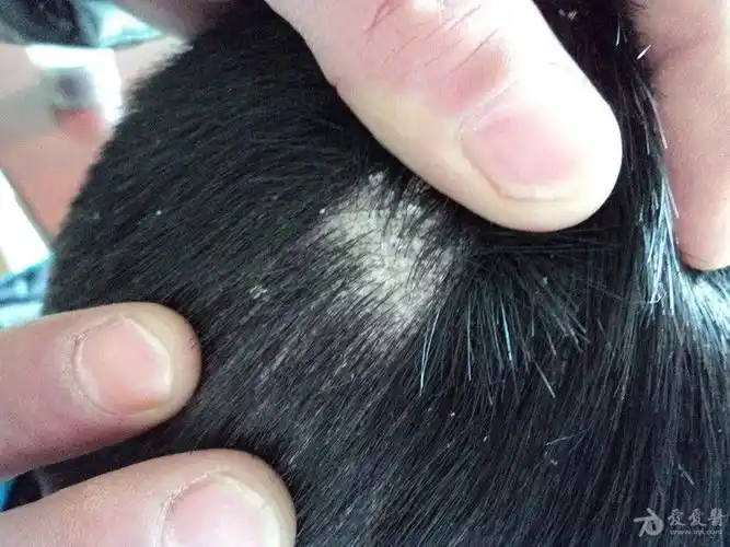 皮肤病增多变厚的头屑石棉状糠疹