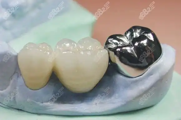 银合金烤瓷牙冠优缺点