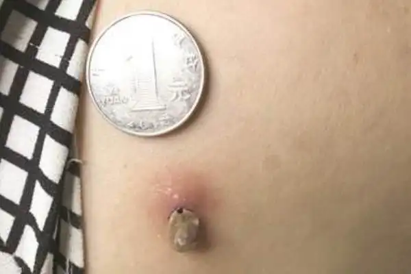 如何鉴别被蜱虫咬了被蜱虫叮咬了怎么办