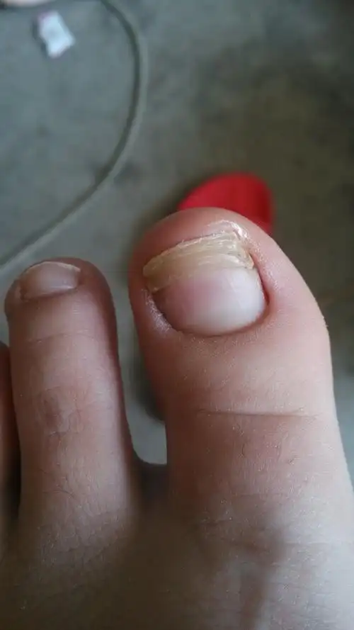 脚趾甲上有横沟怎么办?是缺乏什么营养元素吗?