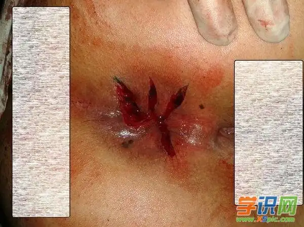 女性痔疮手术后图片 痔疮手术后屁眼图片 女生痔疮手术图片