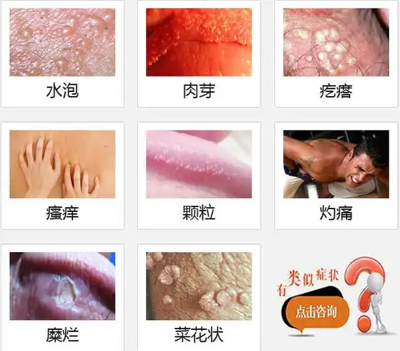 阴茎瘙痒长水泡怎么回事