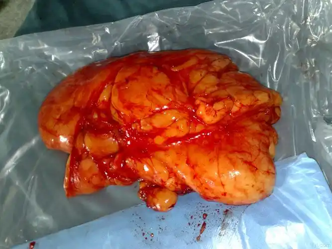 巨大脂肪瘤 要求加精