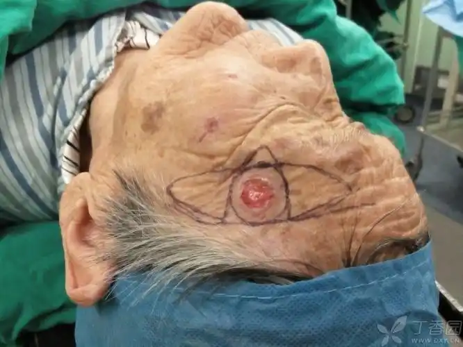 【讨论】最近做的一例皮瓣,基底细胞癌.