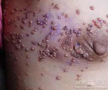 艾滋病潜伏期治疗