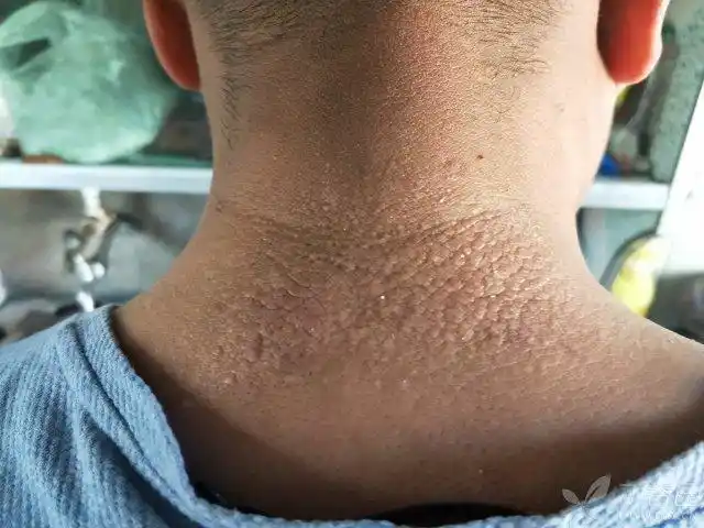 皮疹脖子上这种疹子考虑什么?可以用什么药?求助 [病例帖]