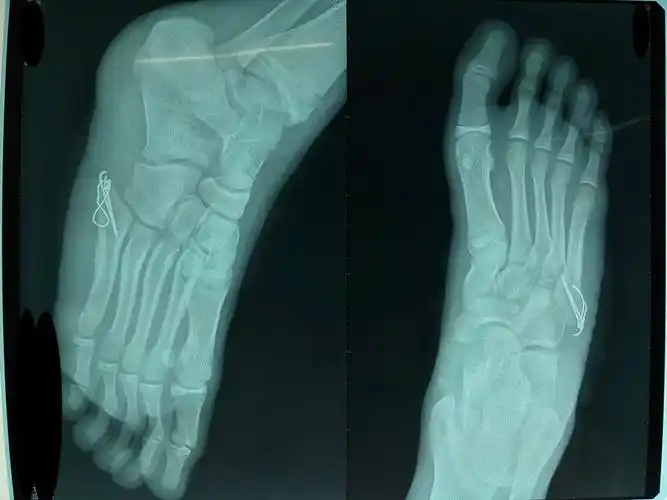 右足第五跖骨基底部骨折
