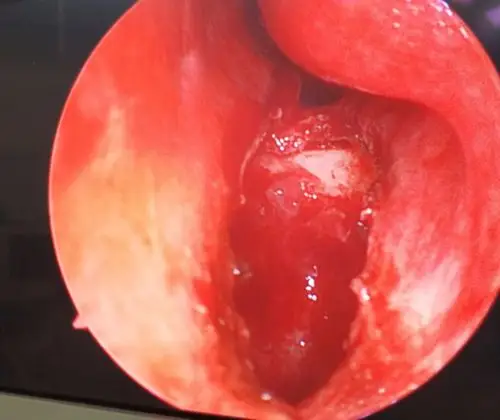 鼻内镜下"开窗"治疗上颌骨囊肿