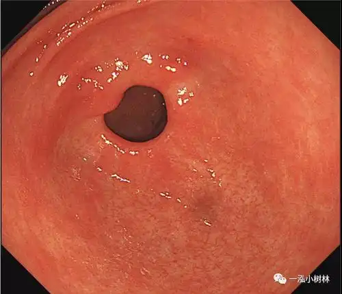 从内镜图像学习a型胃炎自身免疫性胃炎