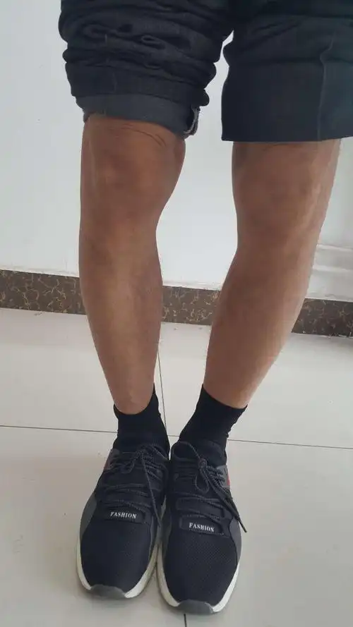 双膝严重骨性关节炎伴膝内翻的保膝治疗.