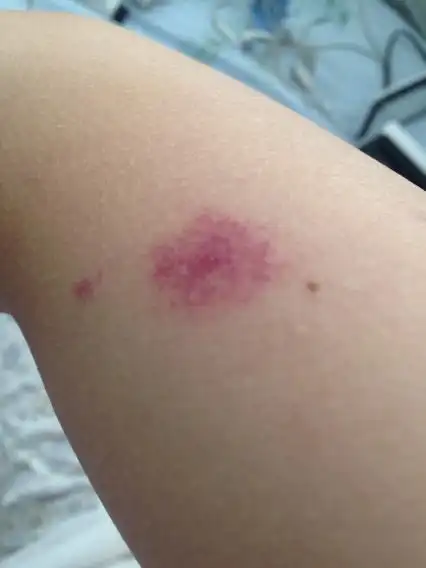 杭州一孕妇被蚊子叮咬,致胎儿命悬一线!蚊子叮咬为何会出现丹毒