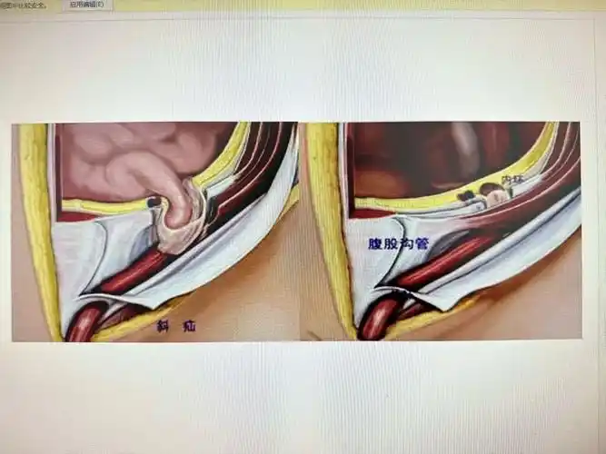 河南大学第一附属医院-先天性腹股沟斜疝-专家在线问诊-京东健康互联