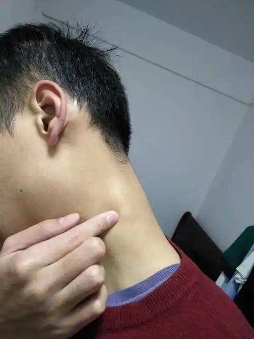 颈后淋巴结肿大