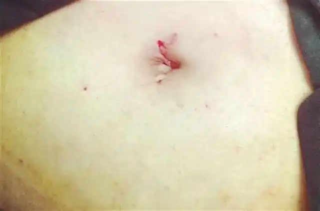 孕妇盆腔长出皮球大卵巢囊肿2厘米手术小孔顺利摘除