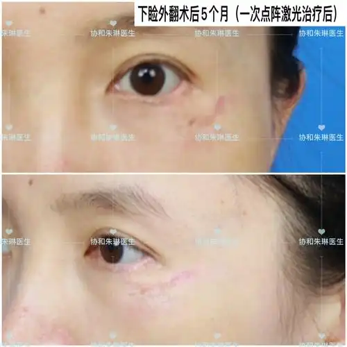 下睑外翻,应该怎么修复,长期效果怎样?