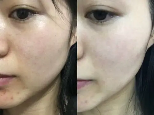 做完前后一周的对比图,光线是有些不一样,肤色其实没_圈子-新氧美容