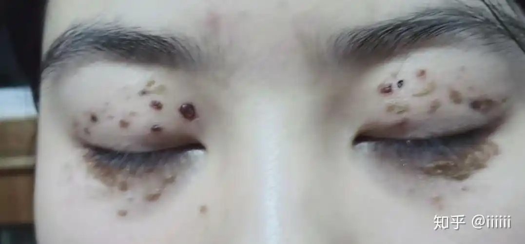 记录上下眼睑汗管瘤的治疗及恢复过程 - 知乎