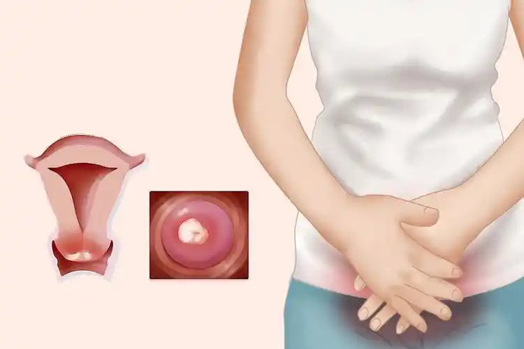 宫颈口发白的图片_39健康网_精编内容