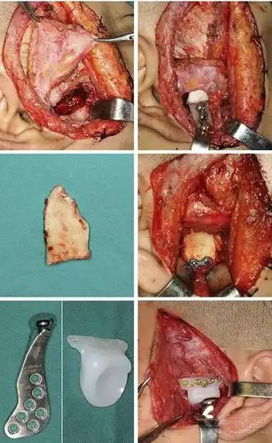 jcs:成人颞下颌关节强直治疗指南