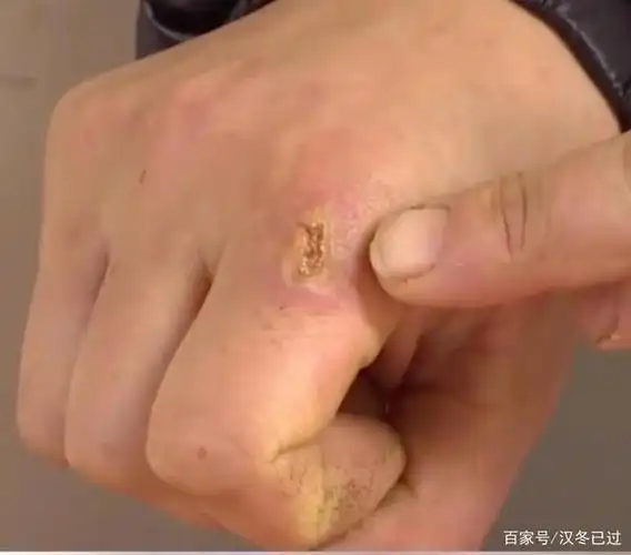 广东惠州:女子网购物品拆出老鼠被咬伤,伤口看得人不寒而栗