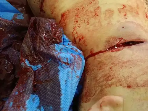 年轻男性,颈动脉破裂出血,血如泉涌,生命垂危.