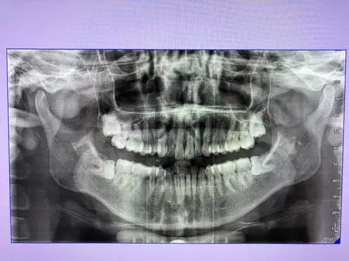 关节盘不可复性移位怎么办