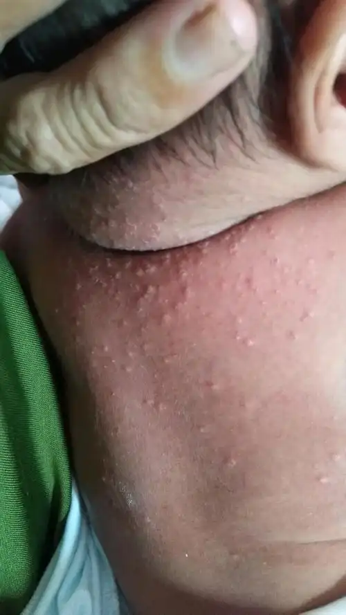 去除婴儿热疹小妙招-婴儿起热疹跟母乳有关吗