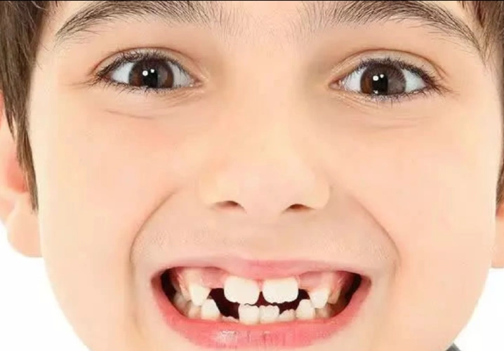 齿生匠心:儿童牙齿稀疏怎么回事?