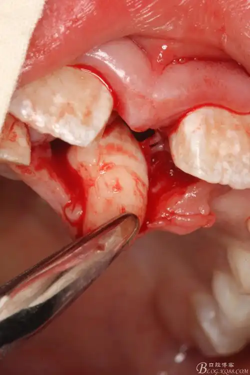 微切口拔除上前牙区域两枚多生牙