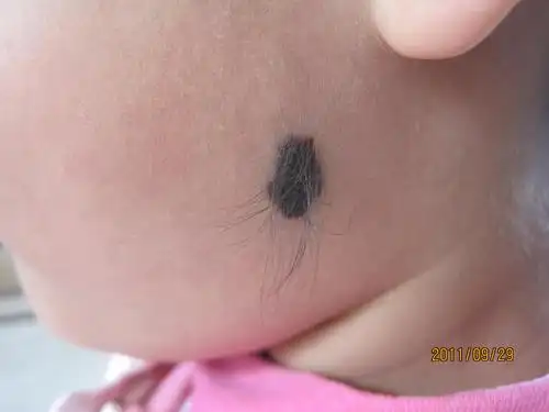 孩子脸上有块黑痣,有稀疏毛毛.