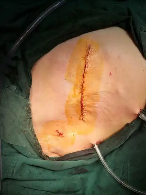 还是扩大根治术和改良根治术,在治疗乳腺癌的同时,都是以切除乳房为