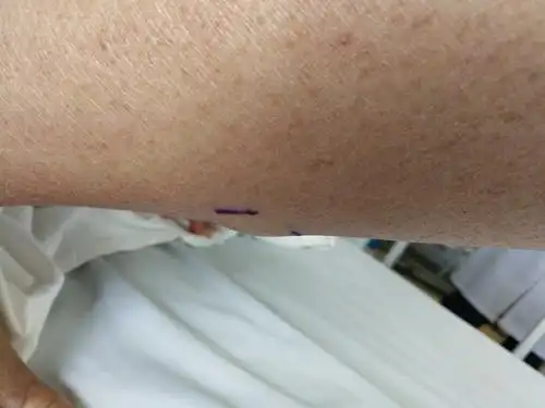 【基本信息】男,18岁,学生病例摘要外科病例普外科病例·右小腿肌疝