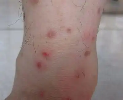 硬下疳初期图片8